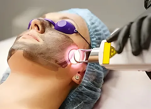 Sesión de láser CO₂ facial